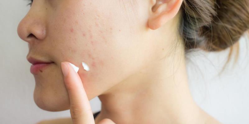 5 Acne Scar Removal Remedies