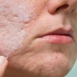 Acne Scar Treatment – 3 Great Ways To Remove Scars