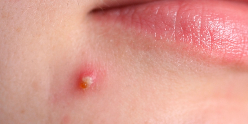 Acne and Acne Information