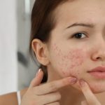 Brief Information about Acne and its Treatment