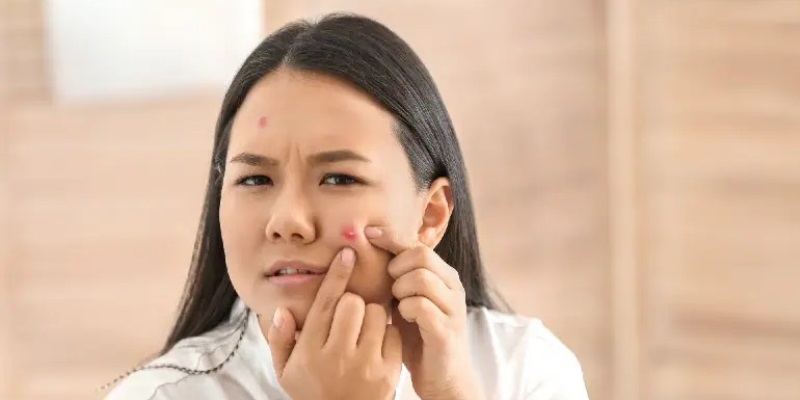 Top 5 Effective Remedy for Acne Treatment